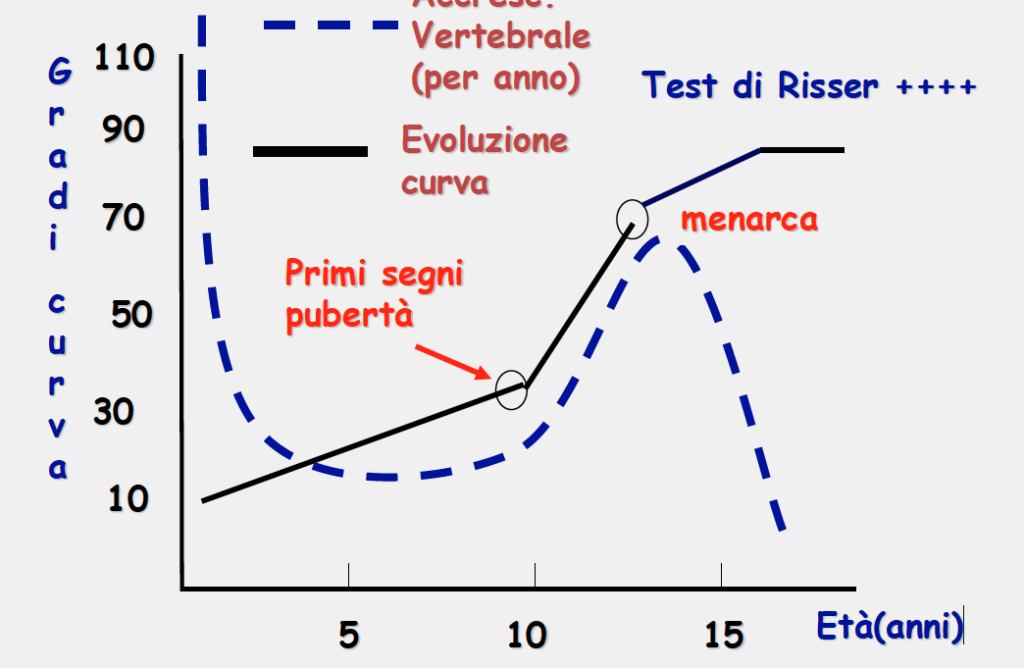la scoliosi ideopatica