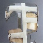 la scoliosi idiopatica