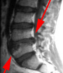 la scoliosi idiopatica