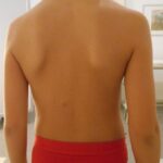 la scoliosi idiopatica