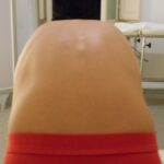 la scoliosi idiopatica