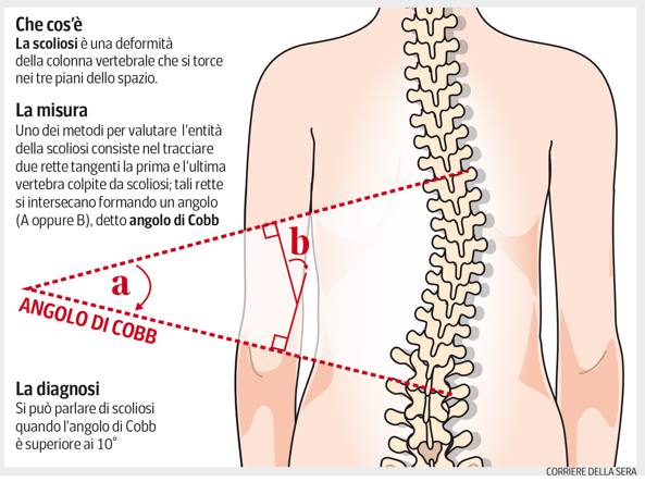la scoliosi idiopatica
