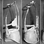 la scoliosi idiopatica