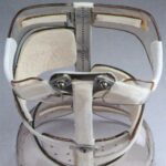 la scoliosi idiopatica