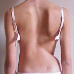 la scoliosi idiopatica