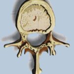 la scoliosi idiopatica