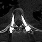 la scoliosi idiopatica