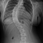 la scoliosi idiopatica