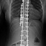 la scoliosi idiopatica