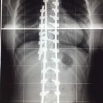 la scoliosi idiopatica