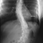 la scoliosi idiopatica