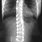 la scoliosi idiopatica