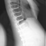 la scoliosi idiopatica