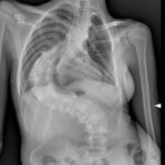 la scoliosi idiopatica