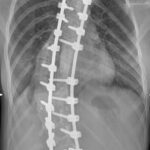 la scoliosi idiopatica