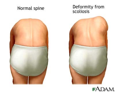 la scoliosi ideopatica