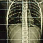 la scoliosi idiopatica